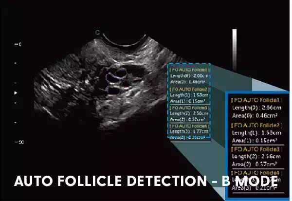 Auto Follicle Detection - B Mode