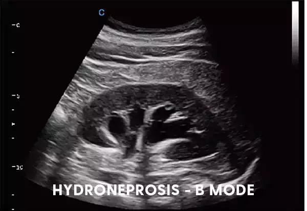 Hydroneprosis - B Mode