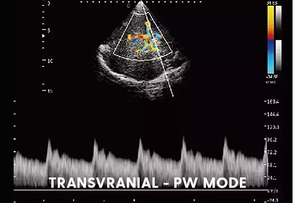 Transvranial - PW Mode